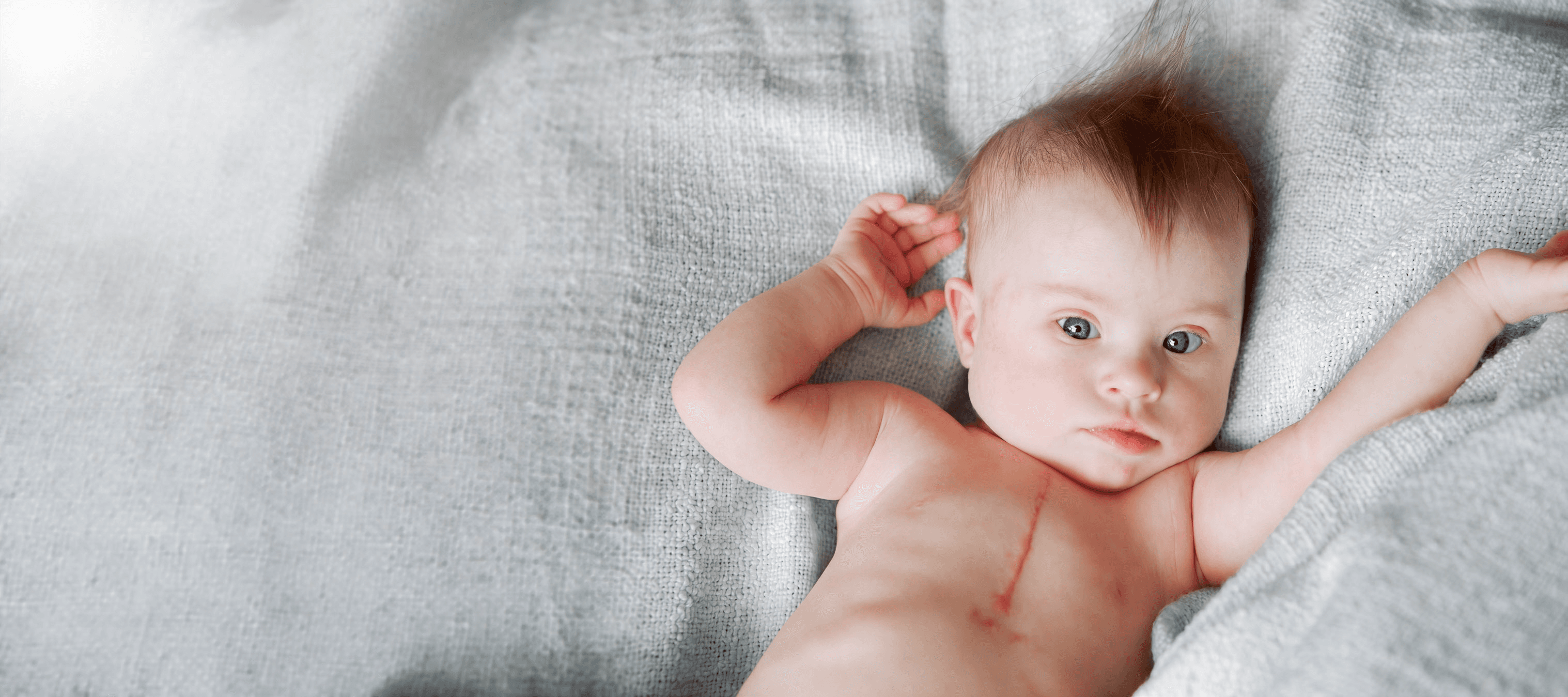 Baby resting on a soft gray blanket with a visible surgical scar